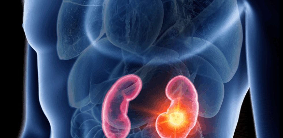 3D medical illustration of human torso showing kidneys with bright highlighted tumor