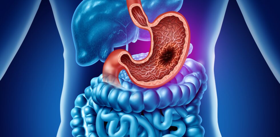 Medical illustration of human digestive system showing stomach ulcer